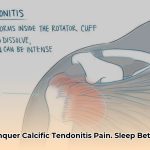 how_to_sleep_with_calcific_tendonitis_edited