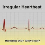 borderline_ecg_meaning_edited