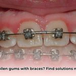 braces_and_gum_swelling_edited