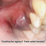 extract_a_tooth_that_is_infected_edited