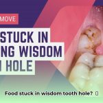 food_stuck_in_wisdom_tooth_hole_edited