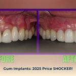 gum_implant_cost_edited