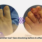 hammer_toes_pictures_before_and_after_edited