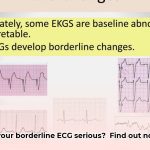 is_borderline_ecg_serious_edited